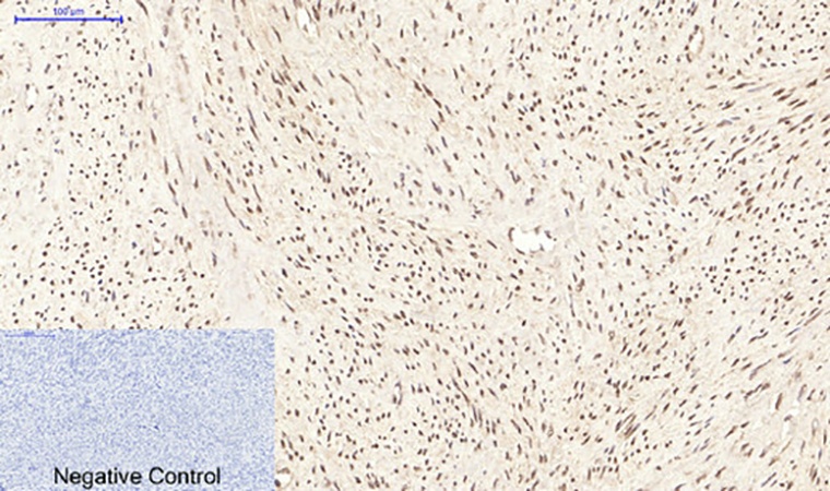 Fig.3. Immunohistochemical analysis of paraffin-embedded human uterus tissue. 1, PPAR Delta Mouse Monoclonal Antibody (2F9) was diluted at 1:200 (4°C, overnight). 2, Sodium citrate pH 6.0 was used for antibody retrieval (>98°C, 20min). 3, secondary antibody was diluted at 1:200 (room temperature, 30min). Negative control was used by secondary antibody only.