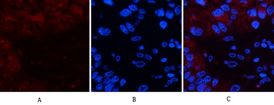 Fig.1. Immunofluorescence analysis of human liver cancer tissue. 1, Cystatin C Mouse Monoclonal Antibody (7F11) (red) was diluted at 1:200 (4°C, overnight). 2, Cy3 Labeled secondary antibody was diluted at 1:300 (room temperature, 50min). 3, Picture B: DAPI (blue) 10min. Picture A: Target. Picture B: DAPI. Picture C: merge of A+B.