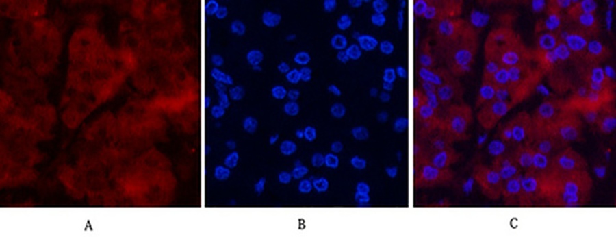 Fig.1. Immunofluorescence analysis of human stomach cancer tissue. 1, Ubiquitin Mouse Monoclonal Antibody (5F1) (red) was diluted at 1:200 (4°C, overnight). 2, Cy3 Labeled secondary antibody was diluted at 1:300 (room temperature, 50min). 3, Picture B: DAPI (blue) 10min. Picture A: Target. Picture B: DAPI. Picture C: merge of A+B.