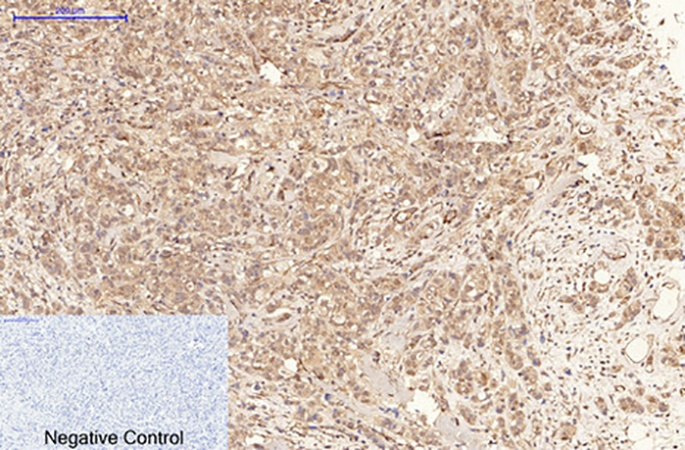 Fig.1. Immunohistochemical analysis of paraffin-embedded human breast cancer tissue. 1, phospho-MLKL (S358) Mouse Monoclonal Antibody (6F8) was diluted at 1:200 (4°C, overnight). 2, Sodium citrate pH 6.0 was used for antibody retrieval (>98°C, 20min). 3, secondary antibody was diluted at 1:200 (room temperature, 30min). Negative control was used by secondary antibody only.