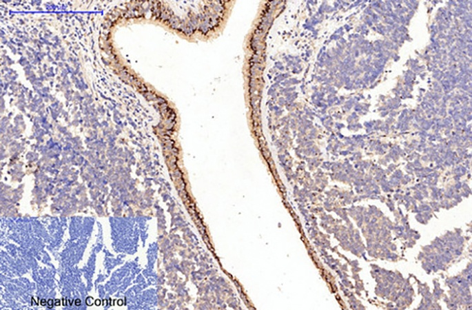 Fig.1. Immunohistochemical analysis of paraffin-embedded human lung cancer tissue. 1, Collagen I Mouse Monoclonal Antibody (4H10) was diluted at 1:200 (4°C, overnight). 2, Sodium citrate pH 6.0 was used for antibody retrieval (>98°C, 20min). 3, secondary antibody was diluted at 1:200 (room temperature, 30min). Negative control was used by secondary antibody only.