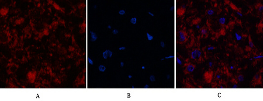 Fig.3. Immunofluorescence analysis of human kidney-cancer tissue. 1, Cleaved-Caspase-3 p12 (D175) Polyclonal Antibody (red) was diluted at 1:200 (4°C, overnight). 2, Cy3 Labeled secondary antibody was diluted at 1:300 (room temperature, 50min). 3, Picture B: DAPI (blue) 10min. Picture A: Target. Picture B: DAPI. Picture C: merge of A+B.