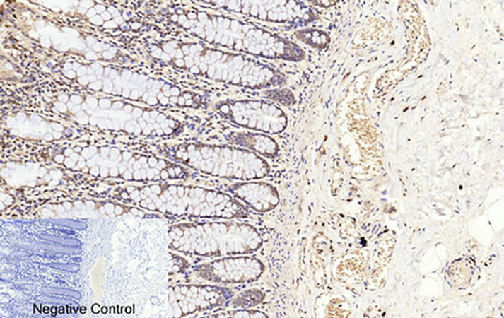 Fig.1. Immunohistochemical analysis of paraffin-embedded human colon tissue. 1, Cleaved-Caspase-3 p17 (D175) Polyclonal Antibody was diluted at 1:200 (4°C, overnight). 2, Sodium citrate pH 6.0 was used for antibody retrieval (>98°C, 20min). 3, secondary antibody was diluted at 1:200 (room temperature, 30min). Negative control was used by secondary antibody only.