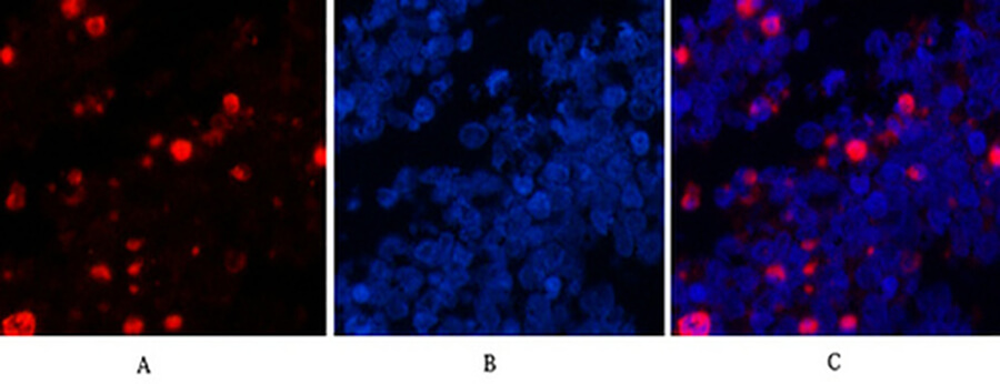Fig.4. Immunofluorescence analysis of human lung cancer tissue. 1, Cleaved-Caspase-3 p17 (D175) Polyclonal Antibody (red) was diluted at 1:200 (4°C,overnight). 2, Cy3 Labeled secondary antibody was diluted at 1:300 (room temperature, 50min). 3, Picture B: DAPI (blue) 10min. Picture A: Target. Picture B: DAPI. Picture C: merge of A+B.