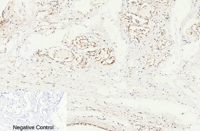 Fig.2. Immunohistochemical analysis of paraffin-embedded human breast tissue. 1, Cleaved-Caspase-8 (D384) Polyclonal Antibody was diluted at 1:200 (4°C, overnight). 2, Sodium citrate pH 6.0 was used for antibody retrieval (>98°C, 20min). 3, secondary antibody was diluted at 1:200 (room temperature, 30min). Negative control was used by secondary antibody only.