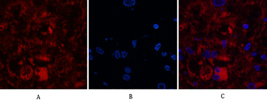 Fig.3. Immunofluorescence analysis of human breast cancer tissue. 1, Cleaved-Caspase-8 (D384) Polyclonal Antibody (red) was diluted at 1:200 (4°C, overnight). 2, Cy3 Labeled secondary antibody was diluted at 1:300 (room temperature, 50min). 3 , Picture B: DAPI (blue) 10min. Picture A: Target. Picture B: DAPI. Picture C: merge of A+B.
