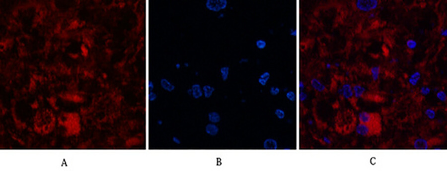 Fig.3. Immunofluorescence analysis of human breast cancer tissue. 1, Cleaved-Caspase-8 (D384) Polyclonal Antibody (red) was diluted at 1:200 (4°C, overnight). 2, Cy3 Labeled secondary antibody was diluted at 1:300 (room temperature, 50min). 3 , Picture B: DAPI (blue) 10min. Picture A: Target. Picture B: DAPI. Picture C: merge of A+B.
