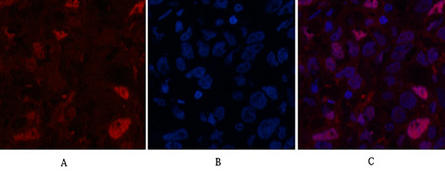 Fig.2. Immunofluorescence analysis of human breast cancer tissue. 1, Caspase-7 Polyclonal Antibody (red) was diluted at 1:200 (4°C, overnight). 2, Cy3 Labeled secondary antibody was diluted at 1:300 (room temperature, 50min). 3, Picture B: DAPI (blue) 10min. Picture A: Target. Picture B: DAPI. Picture C: merge of A+B.