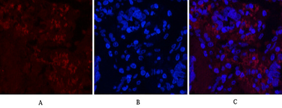 Fig.2. Immunofluorescence analysis of human lung cancer tissue. 1, Cleaved-Notch 1 (V1754) Polyclonal Antibody (red) was diluted at 1:200 (4°C, overnight). 2, Cy3 Labeled secondary antibody was diluted at 1:300 (room temperature, 50min). 3, Picture B: DAPI (blue) 10min. Picture A: Target. Picture B: DAPI. Picture C: merge of A+B.
