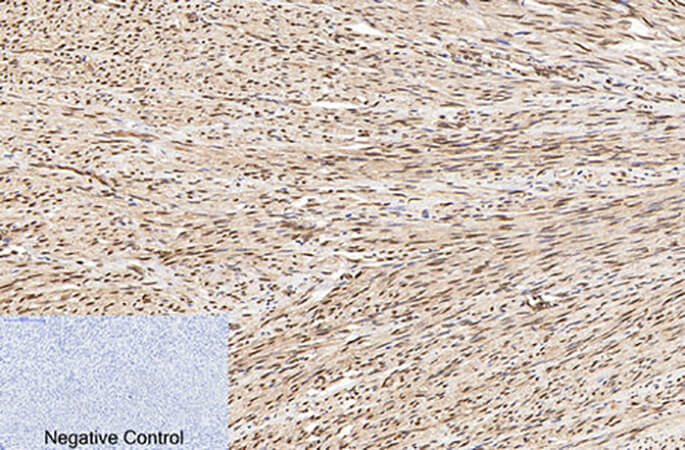Fig.2. Immunohistochemical analysis of paraffin-embedded human uterus tissue. 1, Cleaved-PARP-1 (D214) Polyclonal Antibody was diluted at 1:200 (4°C, overnight). 2, Sodium citrate pH 6.0 was used for antibody retrieval (>98°C, 20min). 3, secondary antibody was diluted at 1:200 (room temperature, 30min). Negative control was used by secondary antibody only.