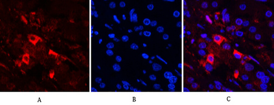 Fig.5. Immunofluorescence analysis of human stomach cancer tissue. 1, Cleaved-PARP-1 (D214) Polyclonal Antibody (red) was diluted at 1:200 (4°C, overnight). 2, Cy3 Labeled secondary antibody was diluted at 1:300 (room temperature, 50min). 3, Picture B: DAPI (blue) 10min. Picture A: Target. Picture B: DAPI. Picture C: merge of A+B.