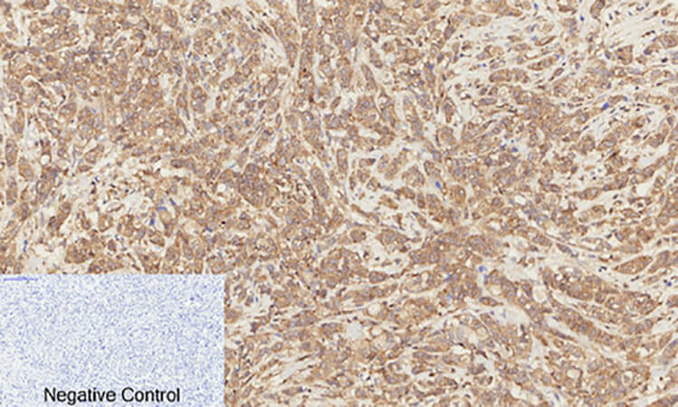 Fig.2. Immunohistochemical analysis of paraffin-embedded human breast cancer tissue. 1, Catenin-β (phospho Ser37) Polyclonal Antibody was diluted at 1:200 (4°C, overnight). 2, Sodium citrate pH 6.0 was used for antibody retrieval (>98°C, 20min). 3, secondary antibody was diluted at 1:200 (room temperature, 30min). Negative control was used by secondary antibody only.