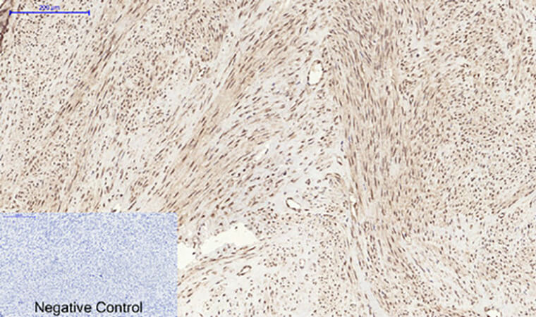 Fig.3. Immunohistochemical analysis of paraffin-embedded human uterus tissue. 1, Stat3 (phospho Ser727) Polyclonal Antibody was diluted at 1:200 (4°C, overnight). 2, Sodium citrate pH 6.0 was used for antibody retrieval (>98°C, 20min). 3, secondary antibody was diluted at 1:200 (room temperature, 30min). Negative control was used by secondary antibody only.