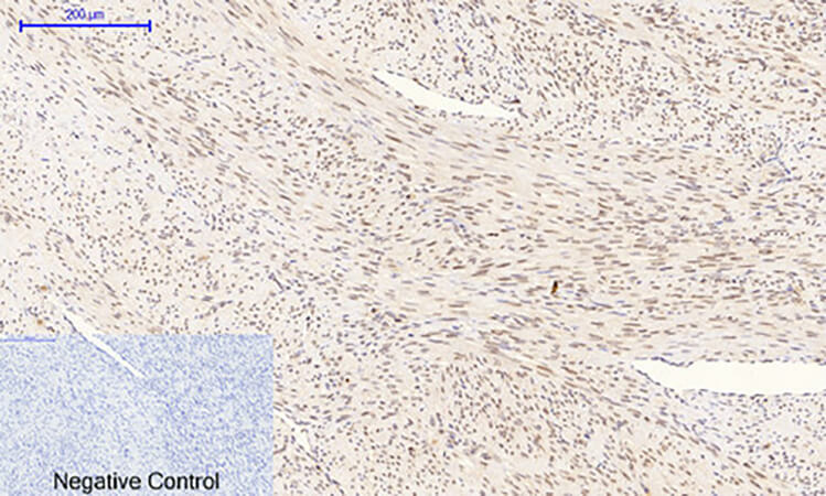 Fig.2. Immunohistochemical analysis of paraffin-embedded human uterus cancer tissue. 1, p38 (phospho Thr180/Y182) Polyclonal Antibody was diluted at 1:200 (4°C, overnight). 2, Sodium citrate pH 6.0 was used for antibody retrieval (>98°C, 20min). 3, secondary antibody was diluted at 1:200 (room temperature, 30min). Negative control was used by secondary antibody only.