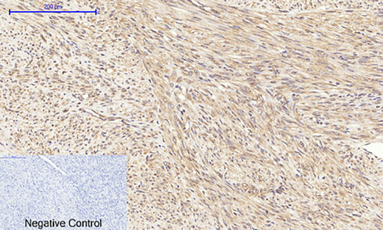 Fig.2. Immunohistochemical analysis of paraffin-embedded human uterus cancer tissue. 1, Akt (phospho Thr308) Polyclonal Antibody was diluted at 1:200 (4°C, overnight). 2, Sodium citrate pH 6.0 was used for antibody retrieval (>98°C, 20min). 3, secondary antibody was diluted at 1:200 (room temperature, 30min). Negative control was used by secondary antibody only.