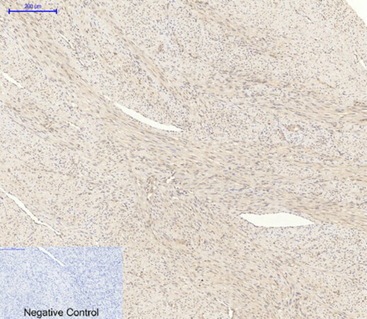 Fig.1. Immunohistochemical analysis of paraffin-embedded human uterus cancer tissue. 1, Akt Polyclonal Antibody was diluted at 1:200 (4°C, overnight). 2, Sodium citrate pH 6.0 was used for antibody retrieval (>98°C, 20min). 3, secondary antibody was diluted at 1:200 (room temperature, 30min). Negative control was used by secondary antibody only.