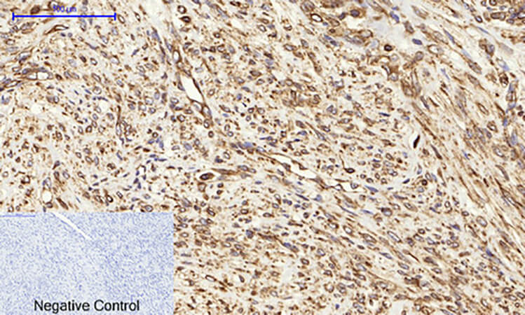 Fig.2. Immunohistochemical analysis of paraffin-embedded human uterus cancer tissue. 1, Calnexin Polyclonal Antibody was diluted at 1:200 (4°C, overnight). 2, Sodium citrate pH 6.0 was used for antibody retrieval (>98°C, 20min). 3, secondary antibody was diluted at 1:200 (room temperature, 30min). Negative control was used by secondary antibody only.