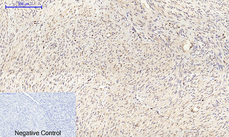 Fig.4. Immunohistochemical analysis of paraffin-embedded human uterus cancer tissue. 1, Connexin 43 Polyclonal Antibody was diluted at 1:200 (4°C, overnight). 2, Sodium citrate pH 6.0 was used for antibody retrieval (>98°C, 20min). 3, secondary antibody was diluted at 1:200 (room temperature, 30min). Negative control was used by secondary antibody only.