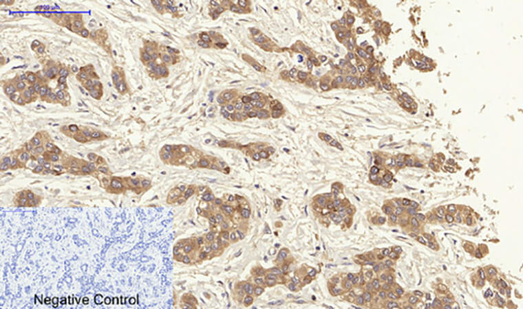 Fig.3. Immunohistochemical analysis of paraffin-embedded human liver cancer tissue. 1, CytokeRatin 19 Polyclonal Antibody was diluted at 1:200 (4°C, overnight). 2, Sodium citrate pH 6.0 was used for antibody retrieval (>98°C, 20min). 3, secondary antibody was diluted at 1:200 (room temperature, 30min). Negative control was used by secondary antibody only.