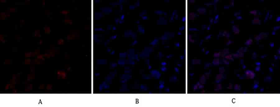 Fig.2. Immunofluorescence analysis of human breast cancer tissue. 1, Dnmt3b Polyclonal Antibody (red) was diluted at 1:200 (4°C, overnight). 2, Cy3 labeled secondary antibody was diluted at 1:300 (room temperature, 50min). 3, Picture B: DAPI (blue) 10min. Picture A: Target. Picture B: DAPI. Picture C: merge of A+B.
