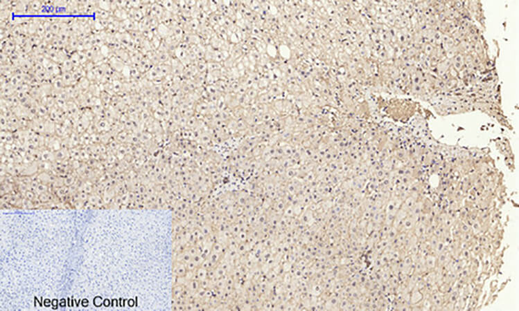 Fig.4. Immunohistochemical analysis of paraffin-embedded human liver tissue. 1, E-cadherin Polyclonal Antibody was diluted at 1:200 (4°C, overnight). 2, Sodium citrate pH 6.0 was used for antibody retrieval (>98°C, 20min). 3, secondary antibody was diluted at 1:200 (room temperature, 30min). Negative control was used by secondary antibody only.