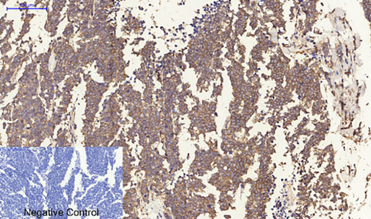 Fig.3. Immunohistochemical analysis of paraffin-embedded human lung cancer tissue. 1, ERβ Polyclonal Antibody was diluted at 1:200 (4°C, overnight). 2, Sodium citrate pH 6.0 was used for antibody retrieval (>98°C, 20min). 3, secondary antibody was diluted at 1:200 (room temperature, 30min). Negative control was used by secondary antibody only.