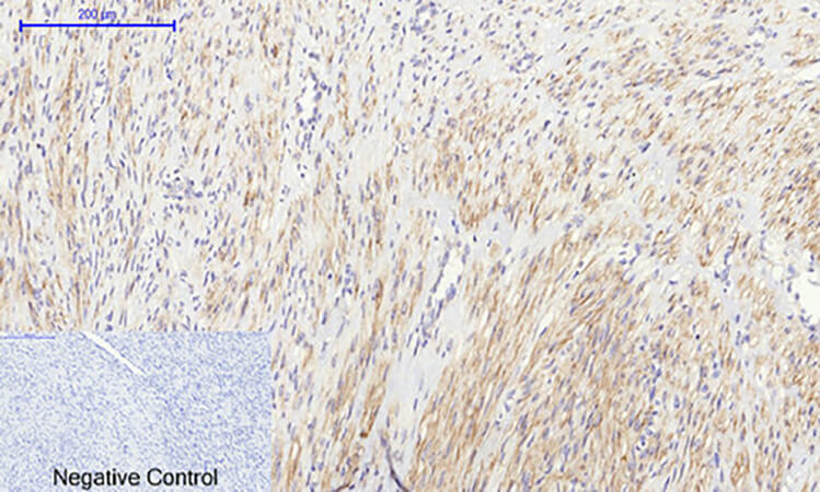 Fig.3. Immunohistochemical analysis of paraffin-embedded human uterus cancer tissue. 1, IκB-α Polyclonal Antibody was diluted at 1:200 (4°C, overnight). 2, Sodium citrate pH 6.0 was used for antibody retrieval (>98°C, 20min). 3, secondary antibody was diluted at 1:200 (room temperature, 30min). Negative control was used by secondary antibody only.