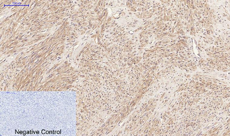 Fig.3. Immunohistochemical analysis of paraffin-embedded human uterus tissue. 1, JAK2 Polyclonal Antibody was diluted at 1:200 (4°C, overnight). 2, Sodium citrate pH 6.0 was used for antibody retrieval (>98°C, 20min). 3, secondary antibody was diluted at 1:200 (room temperature, 30min). Negative control was used by secondary antibody only.