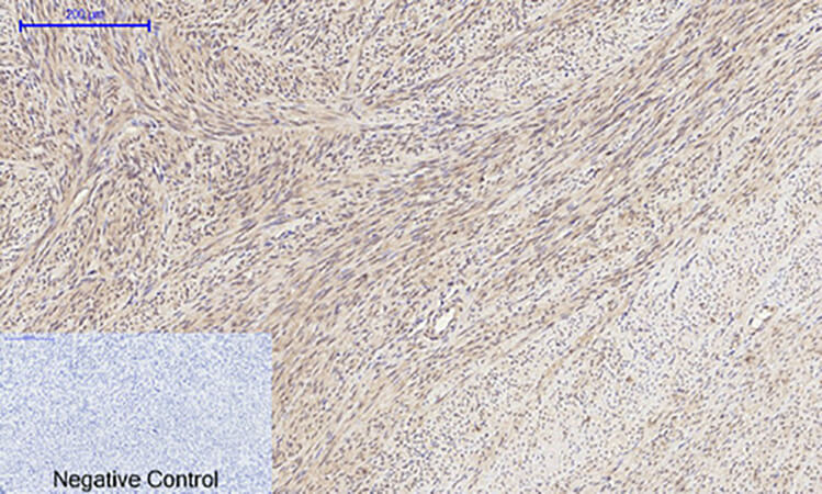 Fig.4. Immunohistochemical analysis of paraffin-embedded human uterus tissue. 1, MMP-2 Polyclonal Antibody was diluted at 1:200 (4°C, overnight). 2, Sodium citrate pH 6.0 was used for antibody retrieval (>98°C, 20min). 3, secondary antibody was diluted at 1:200 (room temperature, 30min). Negative control was used by secondary antibody only.