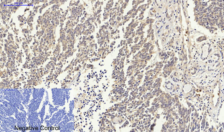 Fig.4. Immunohistochemical analysis of paraffin-embedded human lung cancer tissue. 1, p53 Polyclonal Antibody was diluted at 1:200 (4°C, overnight). 2, Sodium citrate pH 6.0 was used for antibody retrieval (>98°C, 20min). 3, secondary antibody was diluted at 1:200 (room temperature, 30min). Negative control was used by secondary antibody only.