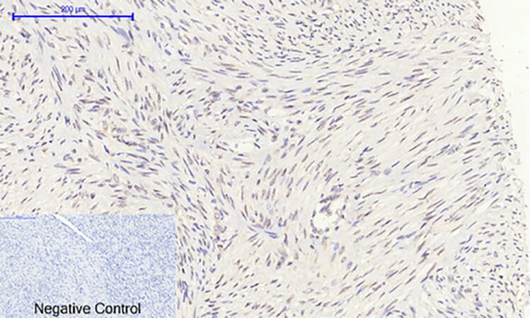 Fig.4. Immunohistochemical analysis of paraffin-embedded human uterus cancer tissue. 1, Rb Polyclonal Antibody was diluted at 1:200 (4°C, overnight). 2, Sodium citrate pH 6.0 was used for antibody retrieval (>98°C, 20min). 3, secondary antibody was diluted at 1:200 (room temperature, 30min). Negative control was used by secondary antibody only.