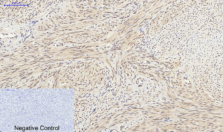 Fig.3. Immunohistochemical analysis of paraffin-embedded human uterus tissue. 1, SIRT1 Polyclonal Antibody was diluted at 1:200 (4°C, overnight). 2, Sodium citrate pH 6.0 was used for antibody retrieval (>98°C, 20min). 3, secondary antibody was diluted at 1:200 (room temperature, 30min). Negative control was used by secondary antibody only.