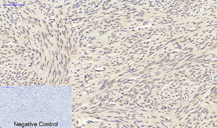 Fig.4. Immunohistochemical analysis of paraffin-embedded human uterus tissue. 1,  Smad3 Polyclonal Antibody was diluted at 1:200 (4°C, overnight). 2,  Sodium citrate pH 6.0 was used for antibody retrieval (>98°C, 20min). 3, secondary antibody was diluted at 1:200 (room temperature, 30min). Negative control was used by secondary antibody only.