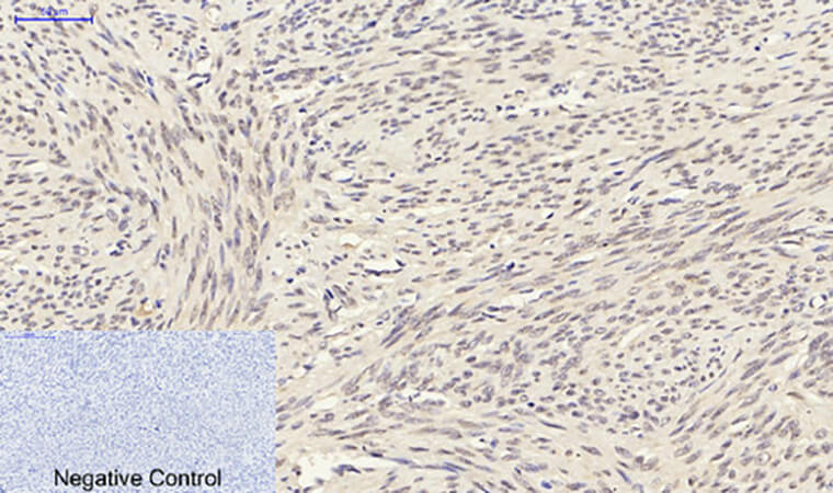 Fig.4. Immunohistochemical analysis of paraffin-embedded human uterus tissue. 1,  Smad3 Polyclonal Antibody was diluted at 1:200 (4°C, overnight). 2,  Sodium citrate pH 6.0 was used for antibody retrieval (>98°C, 20min). 3, secondary antibody was diluted at 1:200 (room temperature, 30min). Negative control was used by secondary antibody only.