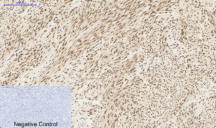 Fig.4. Immunohistochemical analysis of paraffin-embedded human uterus tissue. 1, Stat3 Polyclonal Antibody was diluted at 1:200 (4°C, overnight). 2, Sodium citrate pH 6.0 was used for antibody retrieval (>98°C, 20min). 3, secondary antibody was diluted at 1:200 (room temperature, 30min). Negative control was used by secondary antibody only.