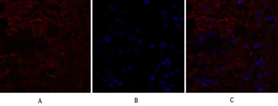 Fig.1. Immunofluorescence analysis of human breast cancer tissue. 1, IL-8 Polyclonal Antibody (red) was diluted at 1:200 (4°C, overnight). 2, Cy3 Labeled secondary antibody was diluted at 1:300 (room temperature, 50min). 3, Picture B: DAPI (blue) 10min. Picture A: Target. Picture B: DAPI. Picture C: merge of A+B.
