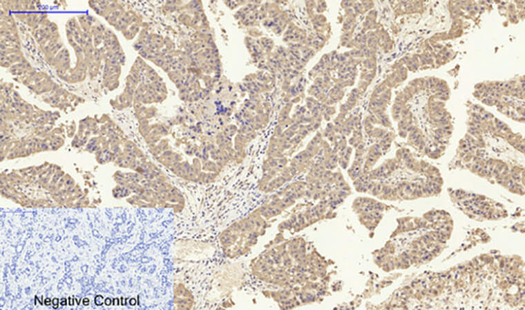 Fig.2. Immunohistochemical analysis of paraffin-embedded human liver cancer tissue. 1, IL-8 Polyclonal Antibody was diluted at 1:200 (4°C, overnight). 2, Sodium citrate pH 6.0 was used for antibody retrieval (>98°C, 20min). 3, secondary antibody was diluted at 1:200 (room temperature, 30min). Negative control was used by secondary antibody only.
