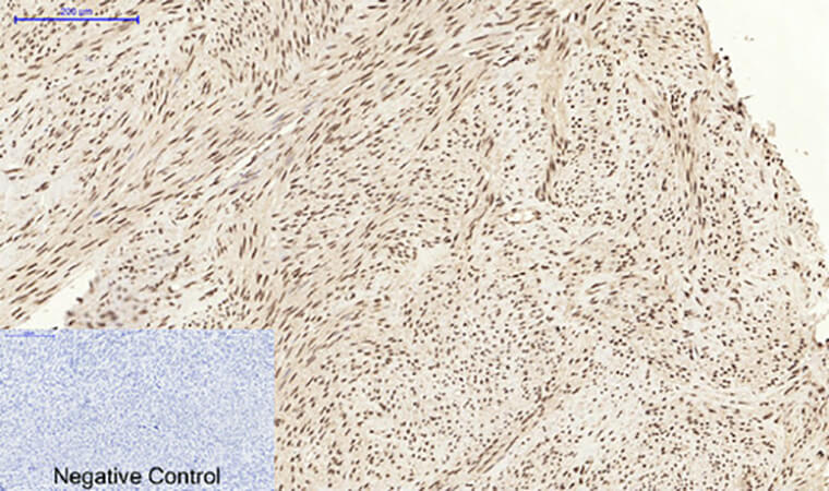 Fig.3. Immunohistochemical analysis of paraffin-embedded human uterus tissue. 1, Caspase-3 Polyclonal Antibody was diluted at 1:200 (4°C, overnight). 2, Sodium citrate pH 6.0 was used for antibody retrieval (>98°C, 20min). 3, secondary antibody was diluted at 1:200 (room temperature, 30min). Negative control was used by secondary antibody only.
