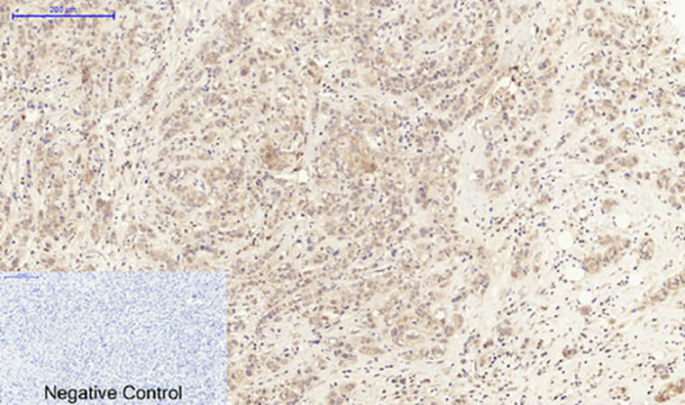 Fig.2. Immunohistochemical analysis of paraffin-embedded human breast cancer tissue. 1, IL-6 Polyclonal Antibody was diluted at 1:200 (4°C, overnight). 2, Sodium citrate pH 6.0 was used for antibody retrieval (>98°C, 20min). 3, secondary antibody was diluted at 1:200 (room temperature, 30min). Negative control was used by secondary antibody only.