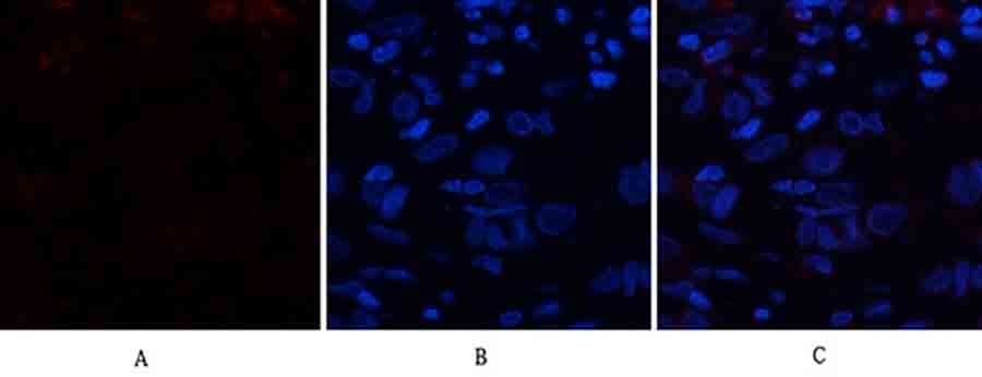 Fig.2. Immunofluorescence analysis of human breast cancer tissue. 1, CD63 Polyclonal Antibody (red) was diluted at 1:200 (4°C, overnight). 2, Cy3 Labeled secondary antibody was diluted at 1:300 (room temperature, 50min). 3, Picture B: DAPI (blue) 10min. Picture A: Target. Picture B: DAPI. Picture C: merge of A+B.