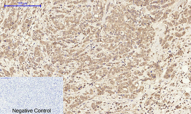 Fig.3. Immunohistochemical analysis of paraffin-embedded human breast cancer tissue. 1, CD63 Polyclonal Antibody was diluted at 1:200 (4°C, overnight). 2, Sodium citrate pH 6.0 was used for antibody retrieval (>98°C, 20min). 3, secondary antibody was diluted at 1:200 (room temperature, 30min). Negative control was used by secondary antibody only.
