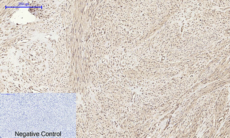 Fig.3. Immunohistochemical analysis of paraffin-embedded human uterus tissue. 1, AR Polyclonal Antibody was diluted at 1:200 (4°C, overnight). 2, Sodium citrate pH 6.0 was used for antibody retrieval (>98°C, 20min). 3, secondary antibody was diluted at 1:200 (room temperature, 30min). Negative control was used by secondary antibody only.