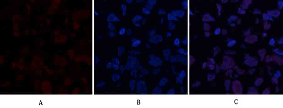 Fig.2. Immunofluorescence analysis of human breast cancer tissue. 1, ABCG2 Polyclonal Antibody (red) was diluted at 1:200 (4°C, overnight). 2, Cy3 Labeled secondary antibody was diluted at 1:300 (room temperature, 50min). 3, Picture B: DAPI (blue) 10min. Picture A: Target. Picture B: DAPI. Picture C: merge of A+B.