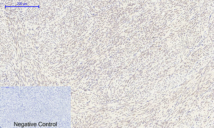 Fig.2. Immunohistochemical analysis of paraffin-embedded human uterus tissue. 1, FoxO1 Polyclonal Antibody was diluted at 1:200 (4°C, overnight). 2, Sodium citrate pH 6.0 was used for antibody retrieval (>98°C, 20min). 3, secondary antibody was diluted at 1:200 (room temperature, 30min). Negative control was used by secondary antibody only.