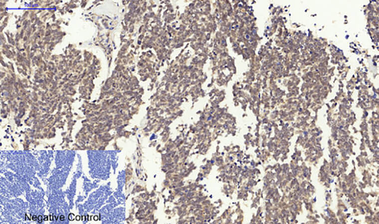 Fig.3. Immunohistochemical analysis of paraffin-embedded human lung cancer tissue. 1, Survivin Polyclonal Antibody was diluted at 1:200 (4°C, overnight). 2, Sodium citrate pH 6.0 was used for antibody retrieval (>98°C, 20min). 3, secondary antibody was diluted at 1:200 (room temperature, 30min). Negative control was used by secondary antibody only.
