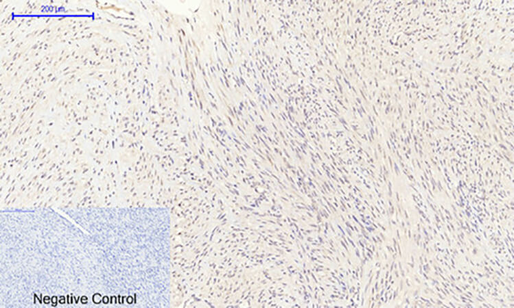 Fig.3. Immunohistochemical analysis of paraffin-embedded human uterus cancer tissue. 1, NOS3 Polyclonal Antibody was diluted at 1:200 (4°C, overnight). 2, Sodium citrate pH 6.0 was used for antibody retrieval (>98°C, 20min). 3, secondary antibody was diluted at 1:200 (room temperature, 30min). Negative control was used by secondary antibody only.