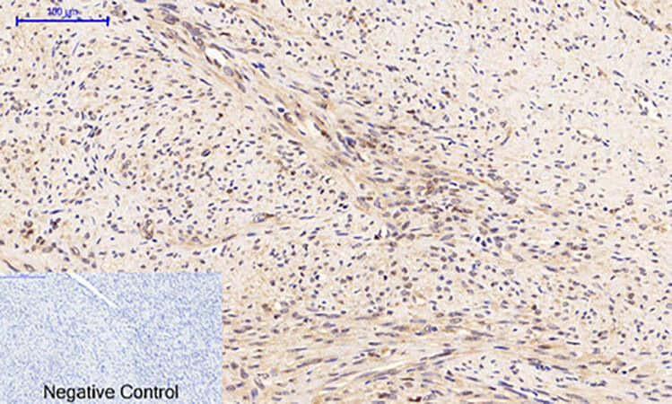 Fig.1. Immunohistochemical analysis of paraffin-embedded human uterus cancer tissue. 1, PTEN (phospho Ser380/T382/T383) Polyclonal Antibody was diluted at 1:200 (4°C, overnight). 2, Sodium citrate pH 6.0 was used for antibody retrieval (>98°C, 20min). 3, secondary antibody was diluted at 1:200 (room temperature, 30min). Negative control was used by secondary antibody only.