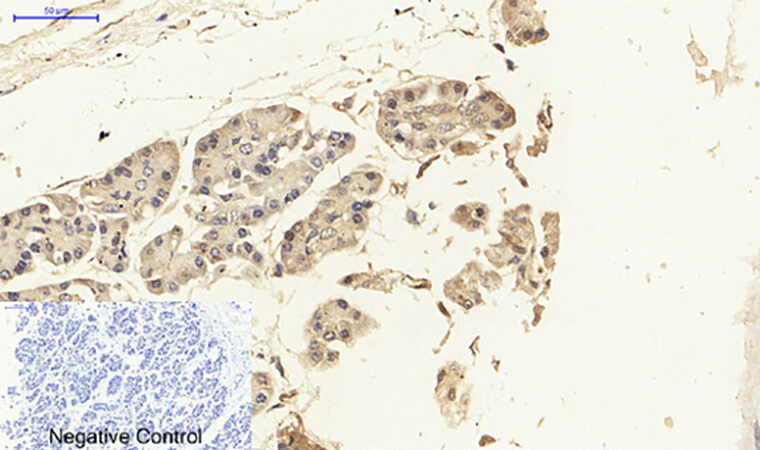 Fig.2. Immunohistochemical analysis of paraffin-embedded human stomach cancer tissue. 1, NFκB-p65 Polyclonal Antibody was diluted at 1:200 (4°C, overnight). 2, Sodium citrate pH 6.0 was used for antibody retrieval (>98°C, 20min). 3, secondary antibody was diluted at 1:200 (room temperature, 30min). Negative control was used by secondary antibody only.