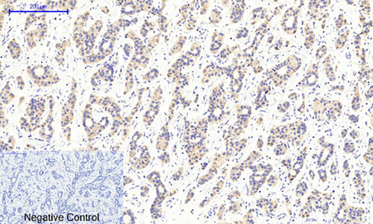 Fig.2. Immunohistochemical analysis of paraffin-embedded human liver cancer tissue. 1, CaMKIIβ/γ/δ (phospho Thr287) Polyclonal Antibody was diluted at 1:200 (4°C, overnight). 2, Sodium citrate pH 6.0 was used for antibody retrieval (>98°C, 20min). 3, secondary antibody was diluted at 1:200 (room temperature, 30min). Negative control was used by secondary antibody only.