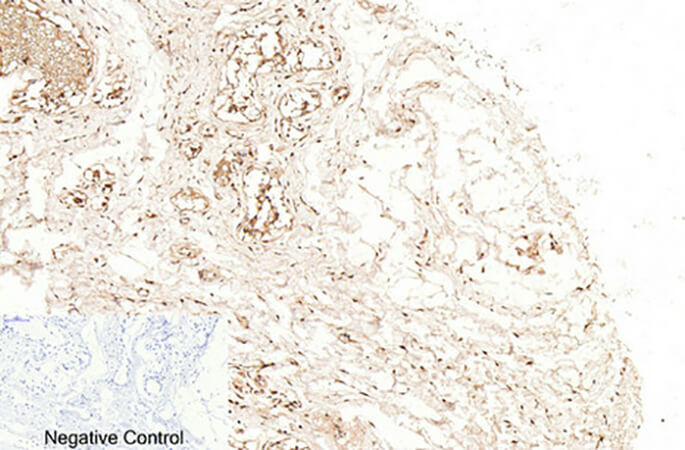 Fig.2. Immunohistochemical analysis of paraffin-embedded human breast tissue. 1, Cleaved-Caspase-1 (D210) Polyclonal Antibody was diluted at 1:200 (4°C, overnight). 2, Sodium citrate pH 6.0 was used for antibody retrieval (>98°C, 20min). 3, secondary antibody was diluted at 1:200 (room temperature, 30min). Negative control was used by secondary antibody only.